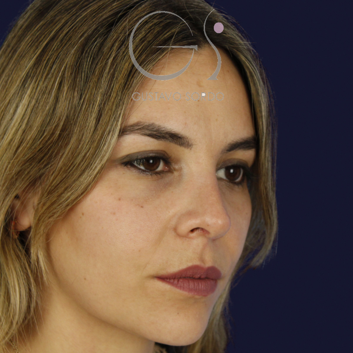 Rinoplastia y eliminación del caballete, semiperfil derecho, a los 7 meses de la cirugía — caso del Dr. Gustavo Sordo en Madrid