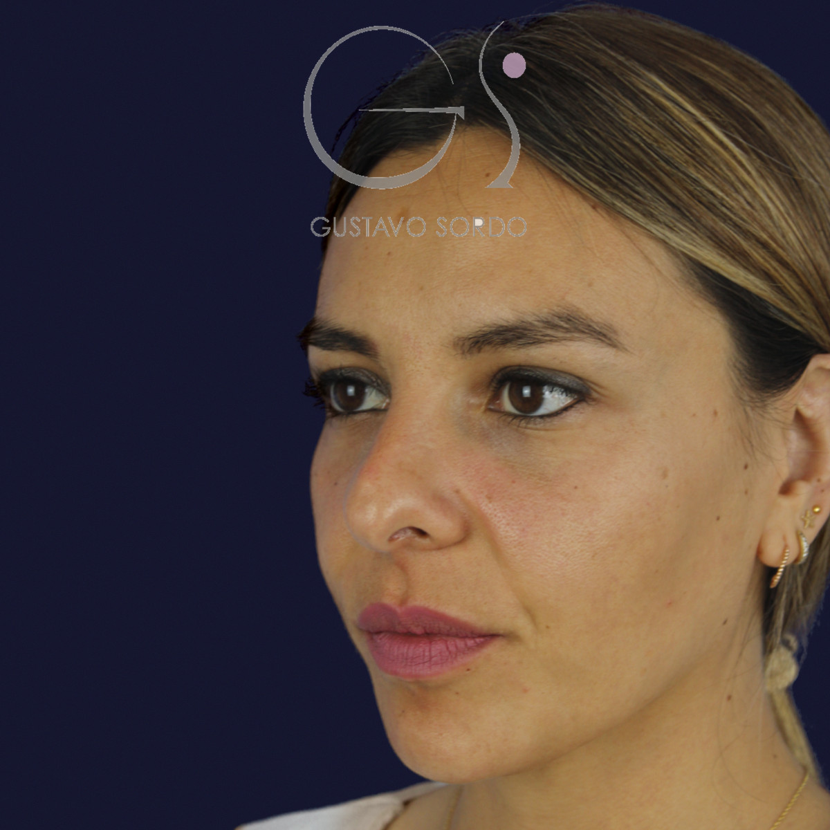 Rinoplastia y eliminación del caballete, semiperfil izquierdo, antes de la cirugía — caso del Dr. Gustavo Sordo en Madrid