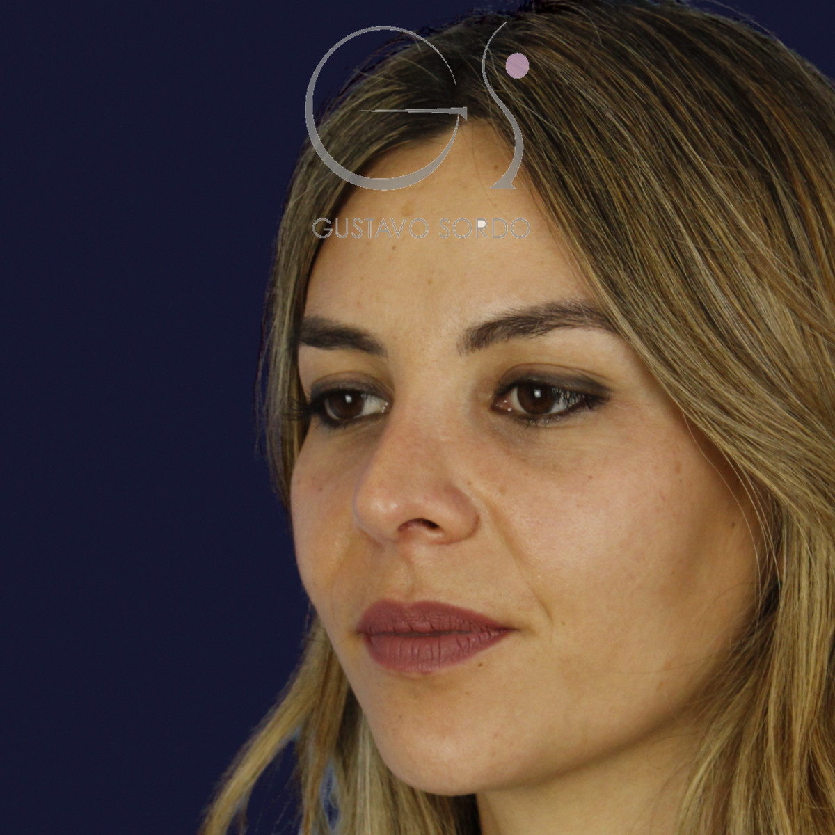 Rinoplastia y eliminación del caballete, semiperfil izquierdo, a los 7 meses de la cirugía — caso del Dr. Gustavo Sordo en Madrid