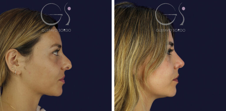 Rinoplastia y eliminación del caballete: perfil derecho antes y a los 7 meses — caso del Dr. Gustavo Sordo en Madrid