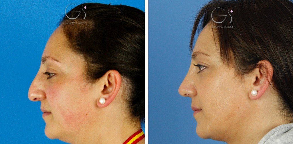 Rinoplastia con punta muy caída y afinamiento de nariz: antes y después de un caso operado en Madrid