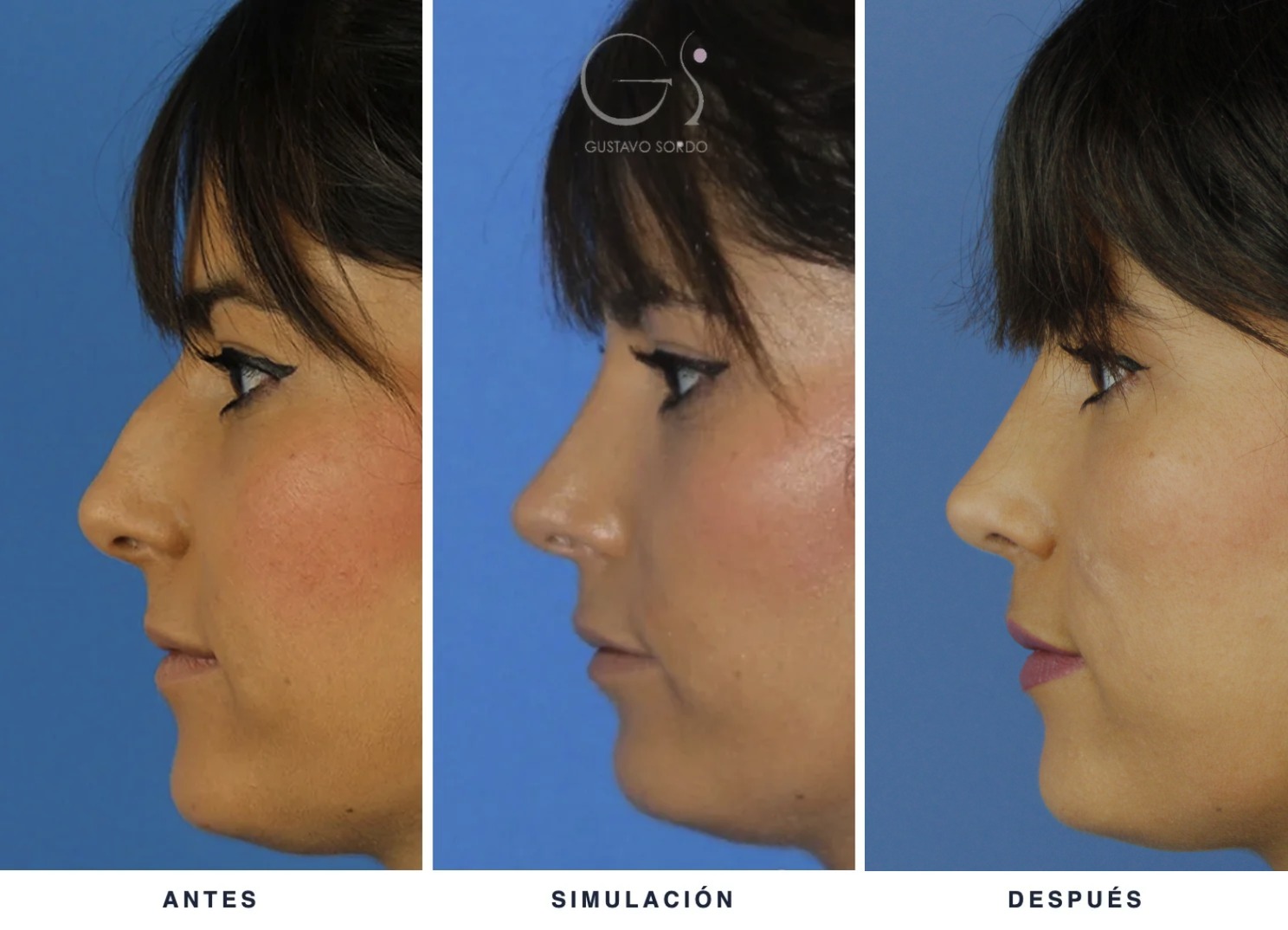 Rinoplastia estructural: antes, simulación 2D y resultado real al año, de perfil — caso del Dr. Gustavo Sordo en Madrid