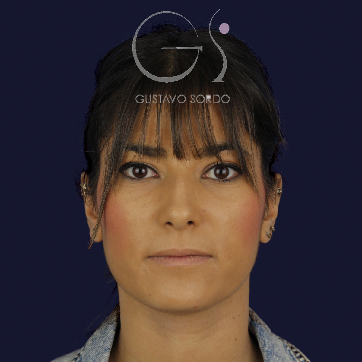 Rinoplastia estructural en piel fina, de frente, antes de la cirugía — caso del Dr. Gustavo Sordo en Madrid