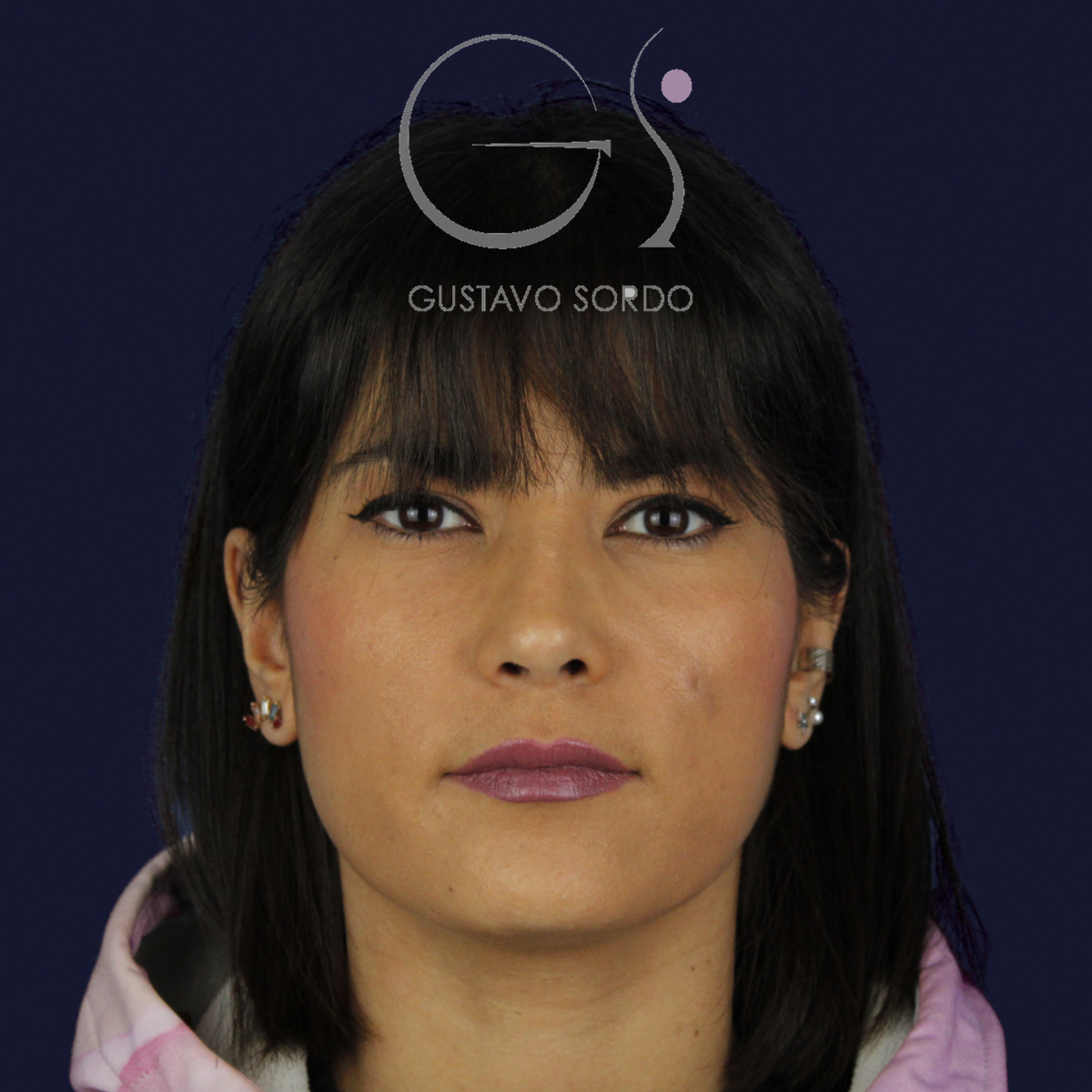 Rinoplastia estructural en piel fina, de frente, al año de la operación — caso del Dr. Gustavo Sordo en Madrid
