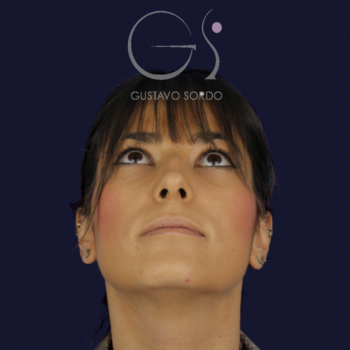 Rinoplastia estructural en piel fina, mentón arriba, antes de la cirugía — caso del Dr. Gustavo Sordo en Madrid