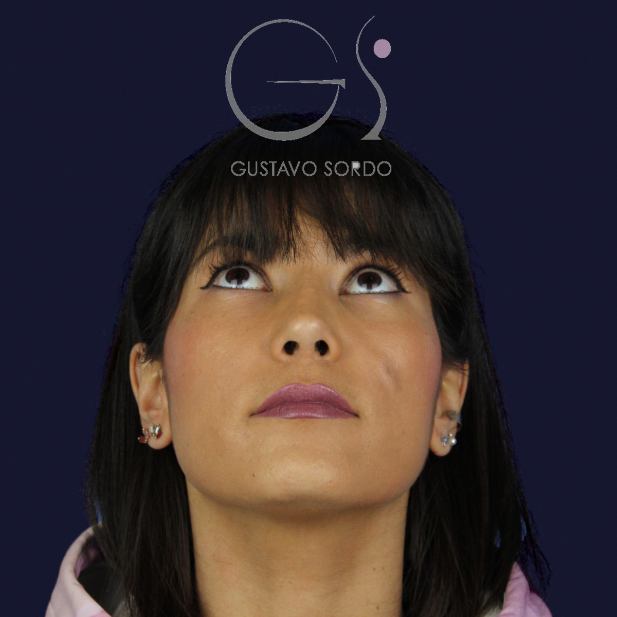Rinoplastia estructural en piel fina, mentón arriba, al año de la operación — caso del Dr. Gustavo Sordo en Madrid