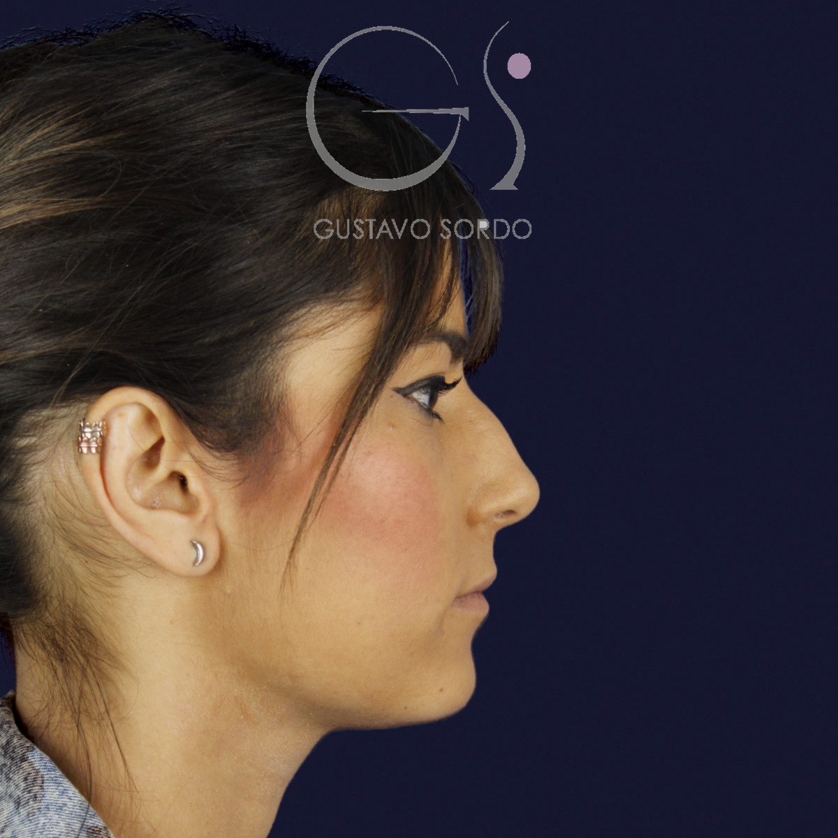 Rinoplastia estructural en piel fina, perfil derecho, antes de la cirugía — caso del Dr. Gustavo Sordo en Madrid