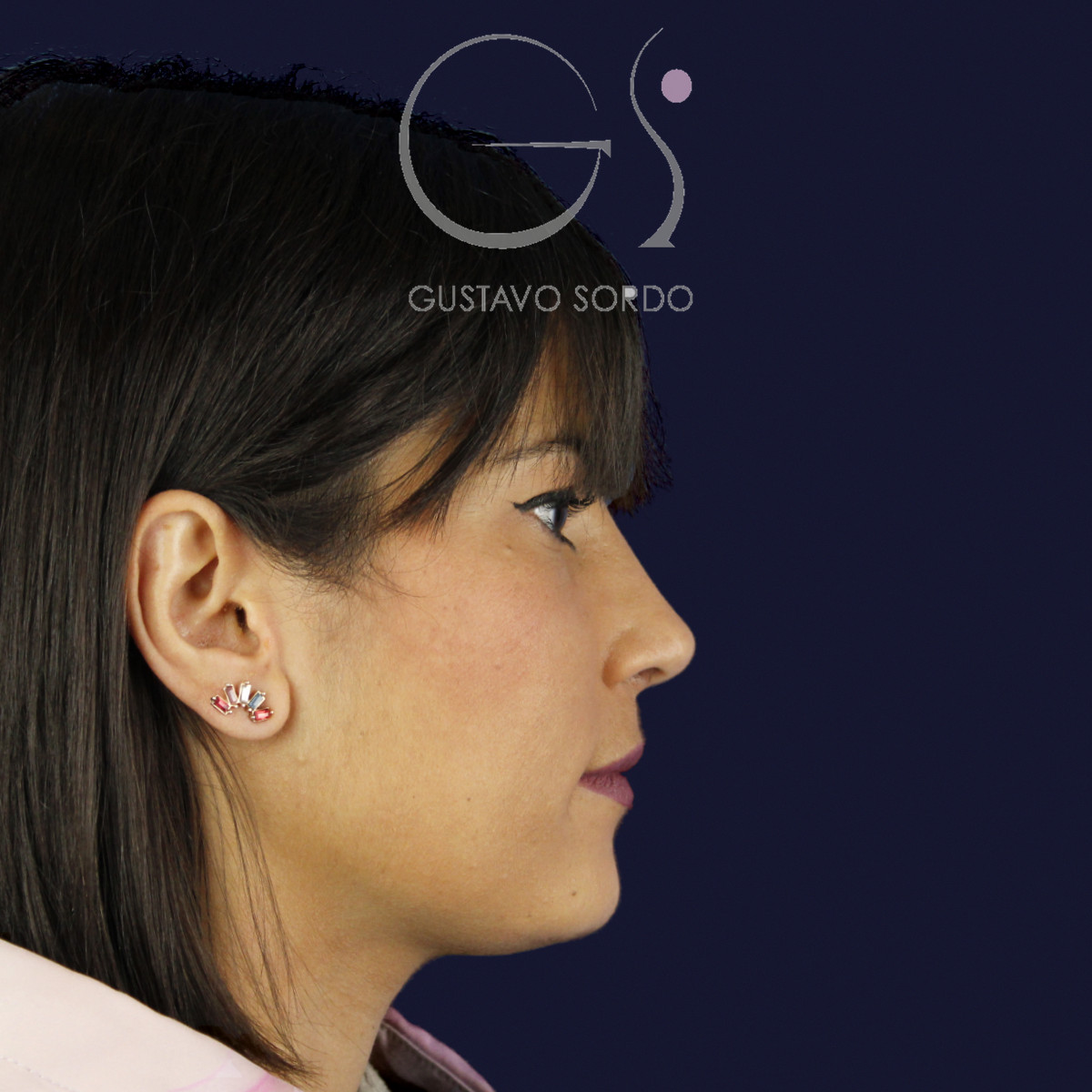 Rinoplastia estructural en piel fina, perfil derecho, al año de la operación — caso del Dr. Gustavo Sordo en Madrid