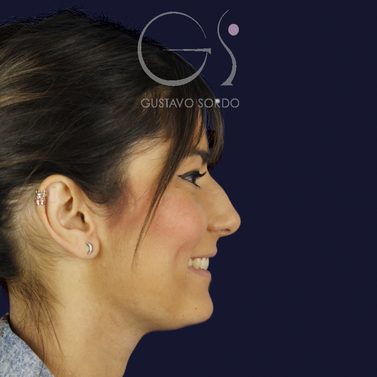 Rinoplastia estructural en piel fina, perfil derecho sonriendo, antes de la cirugía — caso del Dr. Gustavo Sordo en Madrid