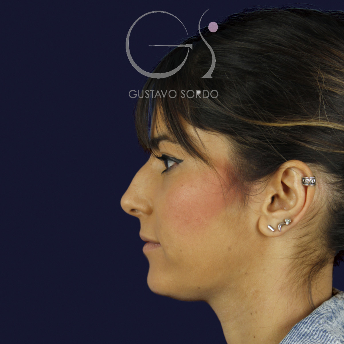Rinoplastia estructural en piel fina, perfil izquierdo, antes de la cirugía — caso del Dr. Gustavo Sordo en Madrid