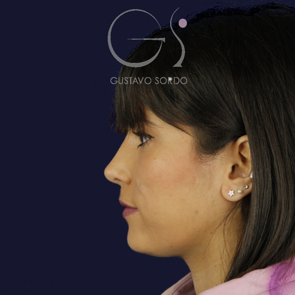 Rinoplastia estructural en piel fina, perfil izquierdo, al año de la operación — caso del Dr. Gustavo Sordo en Madrid