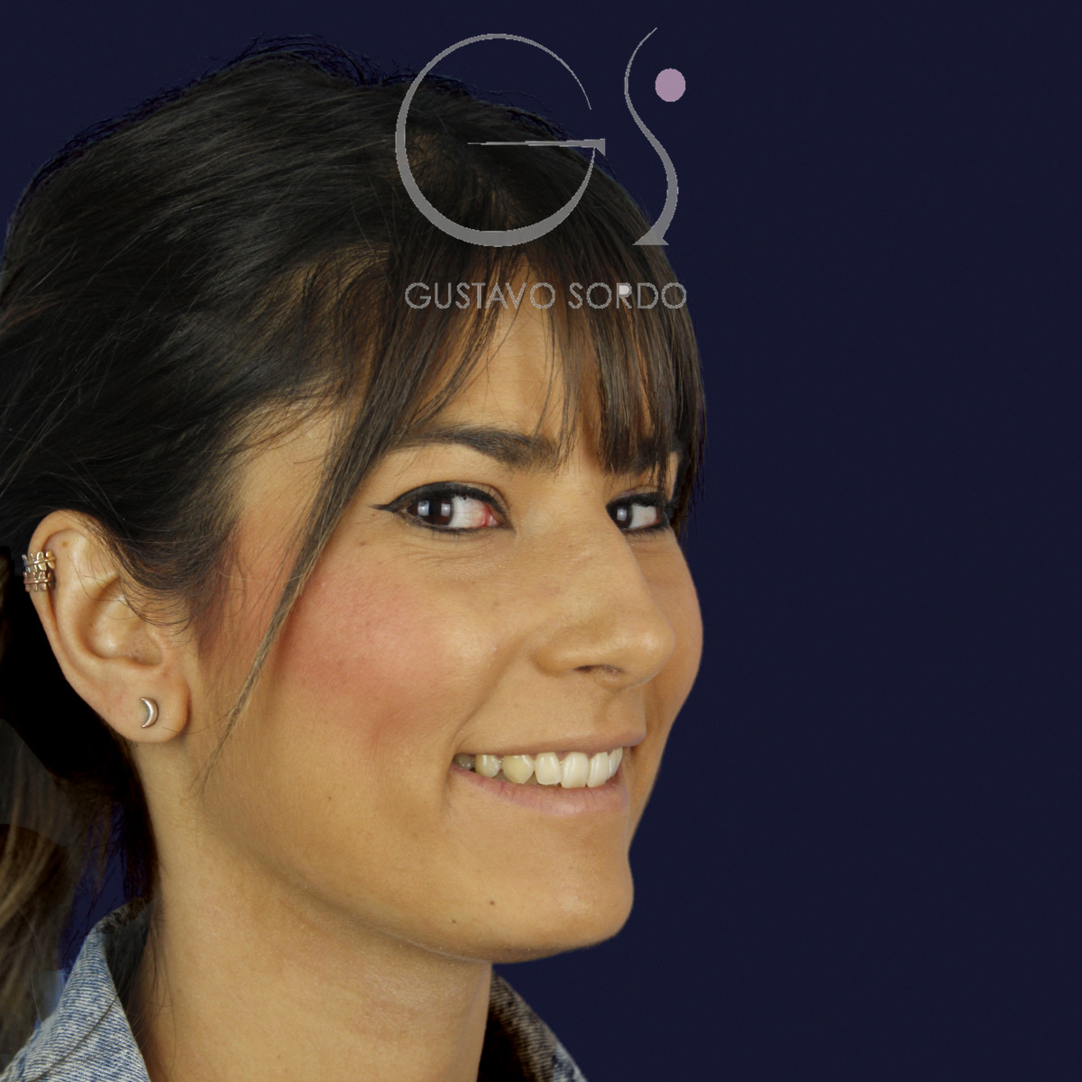 Rinoplastia estructural en piel fina, semiperfil derecho, antes de la cirugía — caso del Dr. Gustavo Sordo en Madrid
