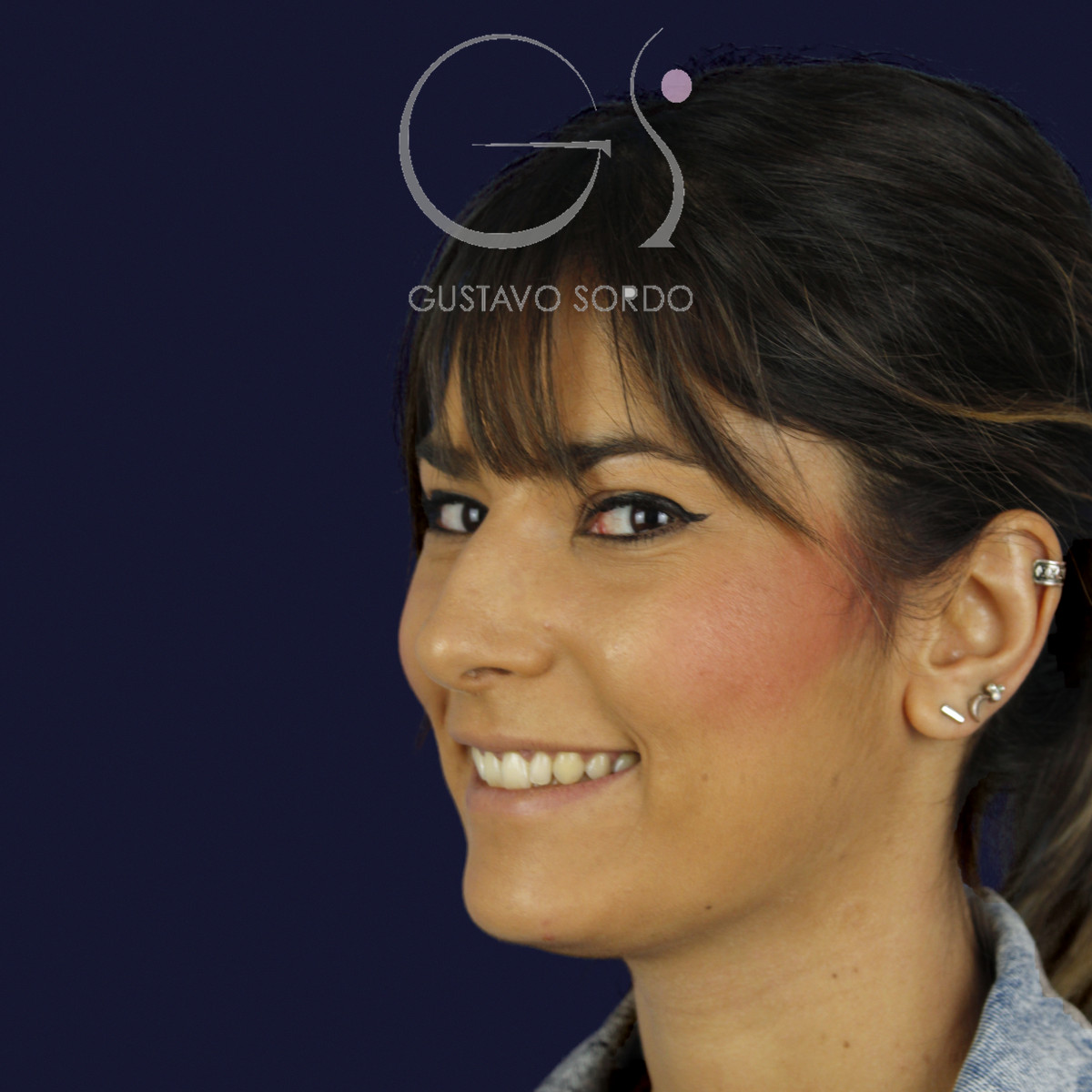 Rinoplastia estructural en piel fina, semiperfil izquierdo, antes de la cirugía — caso del Dr. Gustavo Sordo en Madrid