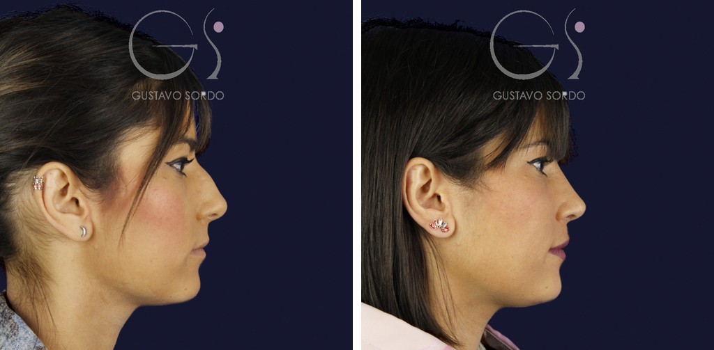 Rinoplastia — técnica ultrasónica, caballete nasal: antes y después de un caso operado en Madrid