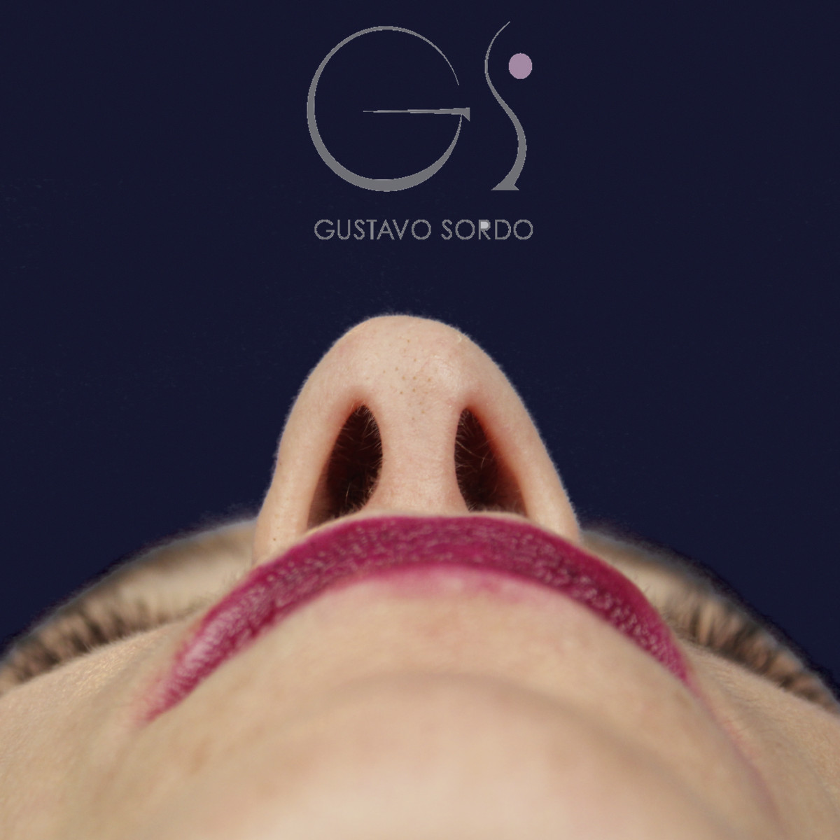 Rinoplastia en nariz larga y piel gruesa, vista basal, antes de la cirugía — caso del Dr. Gustavo Sordo en Madrid