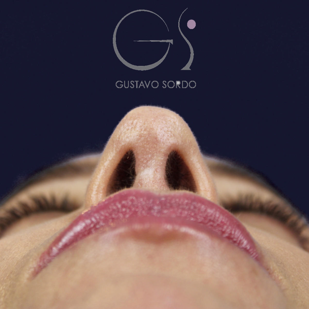Rinoplastia en nariz larga y piel gruesa, vista basal, al año de la cirugía — caso del Dr. Gustavo Sordo en Madrid