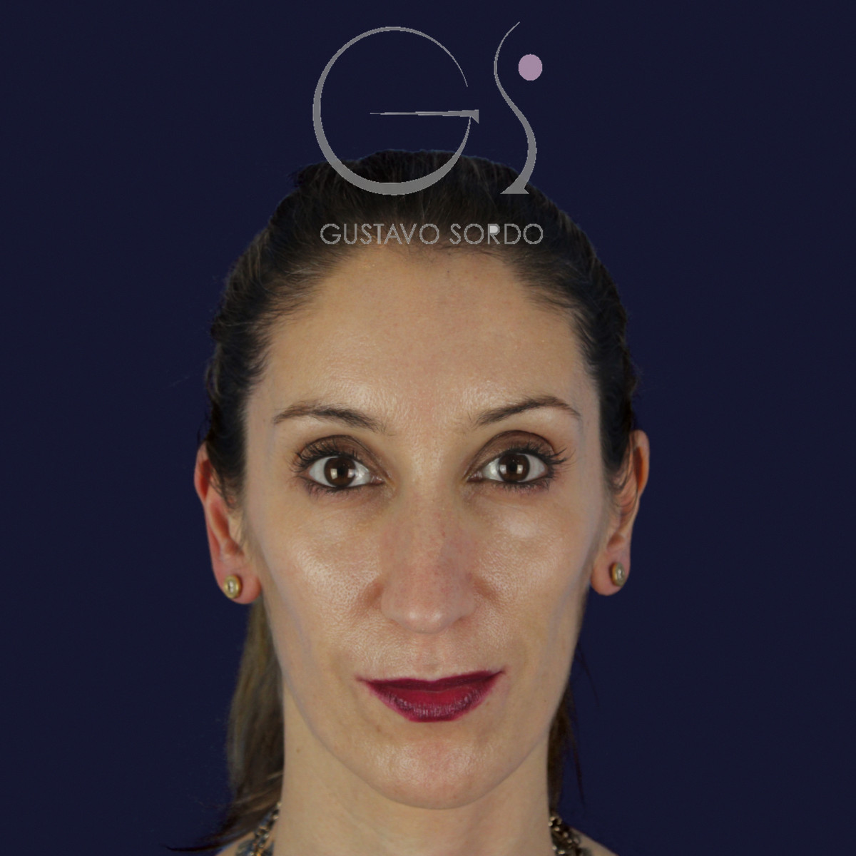 Rinoplastia en nariz larga y piel gruesa, de frente, antes de la cirugía — caso del Dr. Gustavo Sordo en Madrid