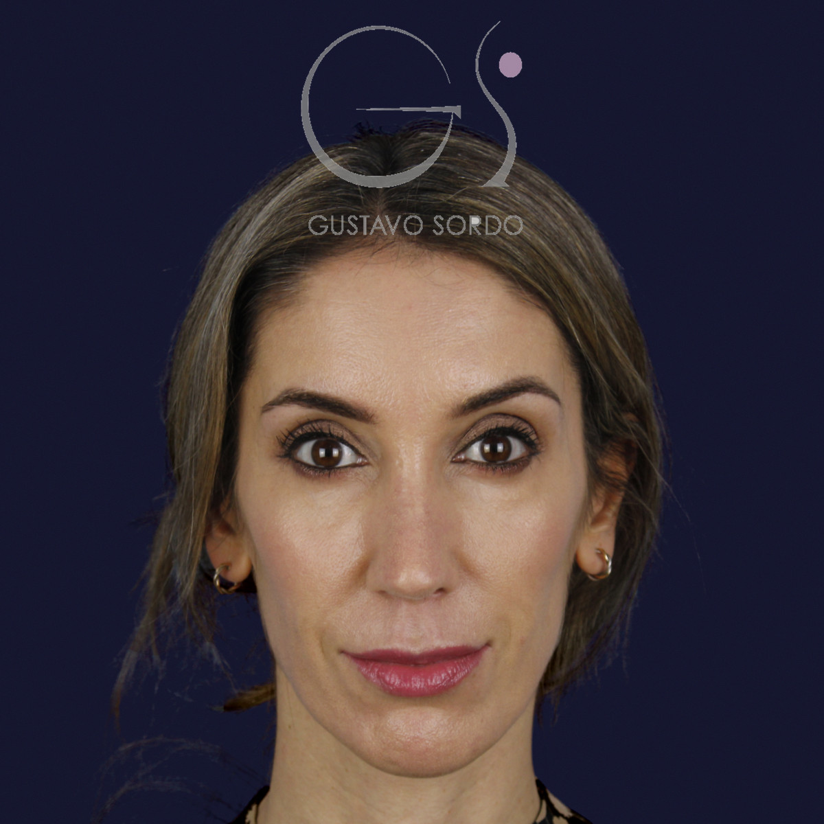 Rinoplastia en nariz larga y piel gruesa, de frente, al año de la cirugía — caso del Dr. Gustavo Sordo en Madrid