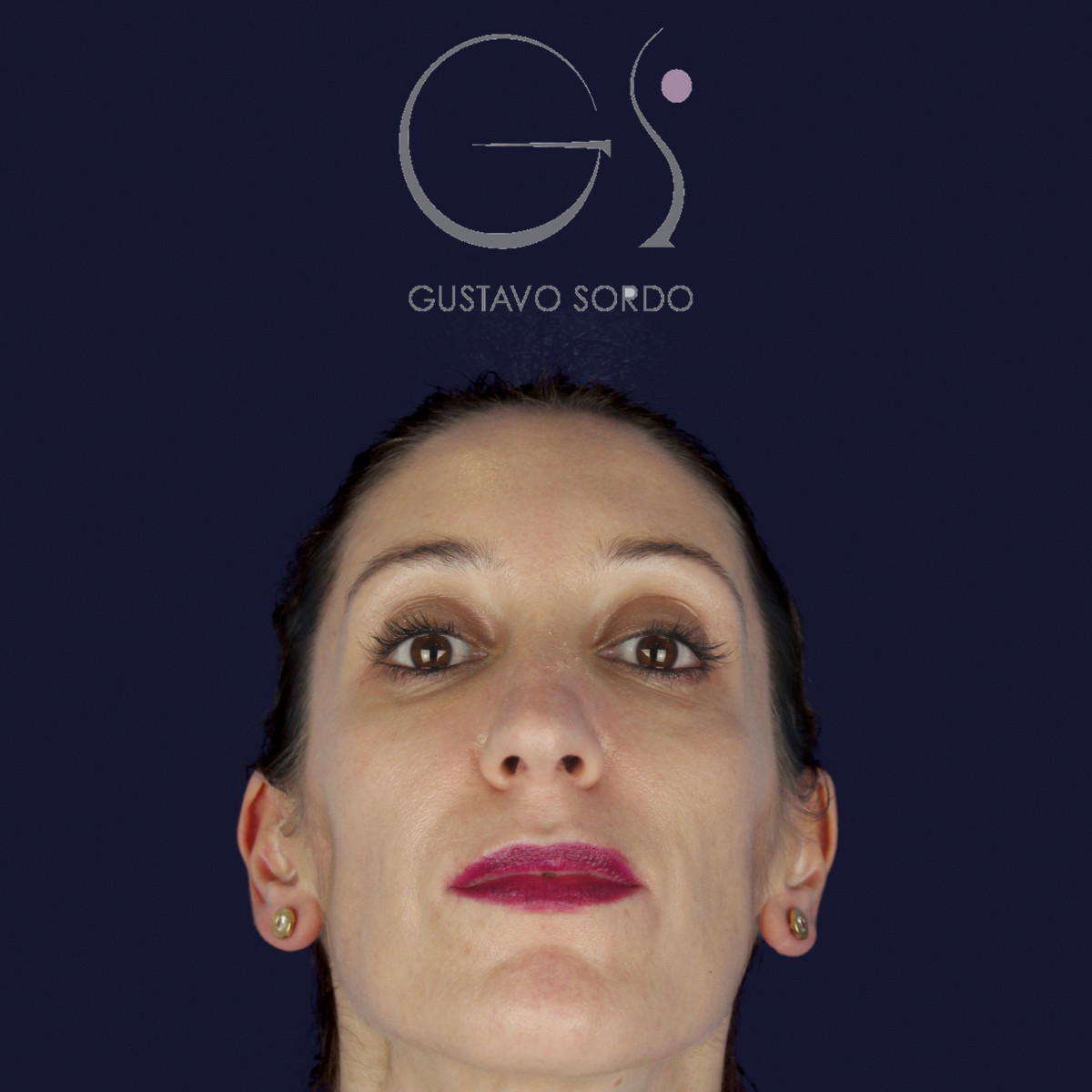 Rinoplastia en nariz larga y piel gruesa, mentón arriba, antes de la cirugía — caso del Dr. Gustavo Sordo en Madrid