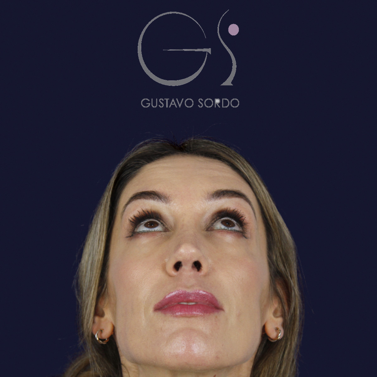 Rinoplastia en nariz larga y piel gruesa, mentón arriba, al año de la cirugía — caso del Dr. Gustavo Sordo en Madrid