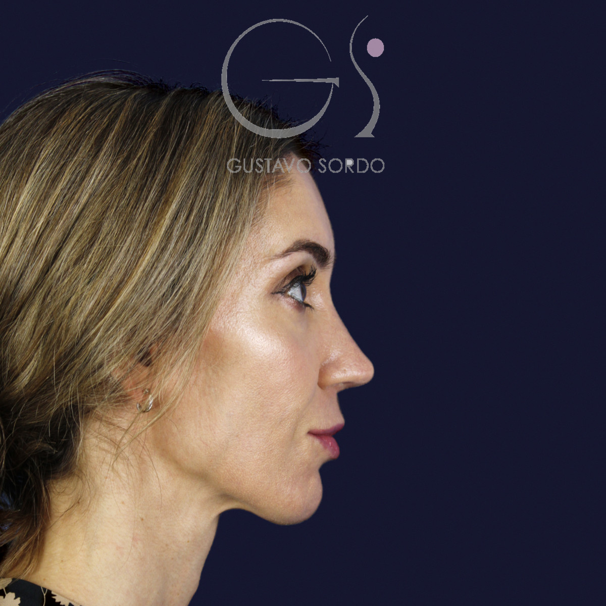 Rinoplastia en nariz larga y piel gruesa, perfil derecho, al año de la cirugía — caso del Dr. Gustavo Sordo en Madrid