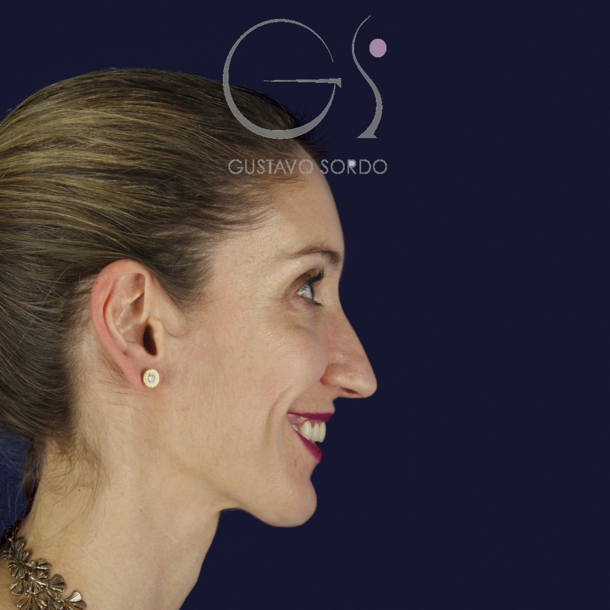 Rinoplastia en nariz larga y piel gruesa, perfil derecho sonriendo, antes de la cirugía — caso del Dr. Gustavo Sordo en Madrid
