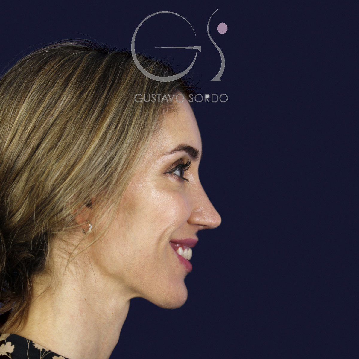 Rinoplastia en nariz larga y piel gruesa, perfil derecho sonriendo, al año de la cirugía — caso del Dr. Gustavo Sordo en Madrid