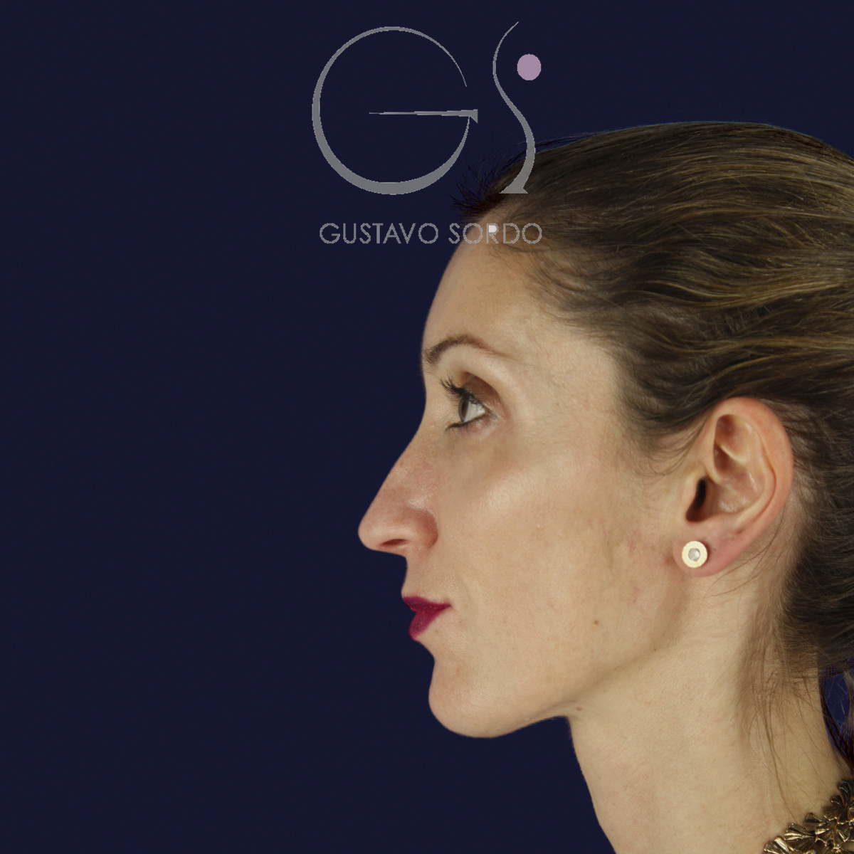 Rinoplastia en nariz larga y piel gruesa, perfil izquierdo, antes de la cirugía — caso del Dr. Gustavo Sordo en Madrid