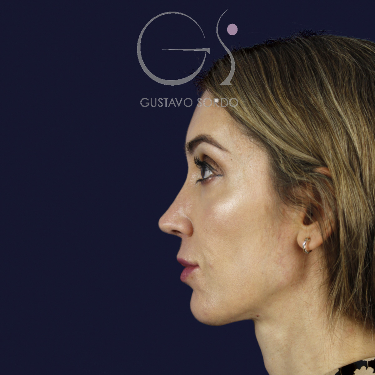 Rinoplastia en nariz larga y piel gruesa, perfil izquierdo, al año de la cirugía — caso del Dr. Gustavo Sordo en Madrid