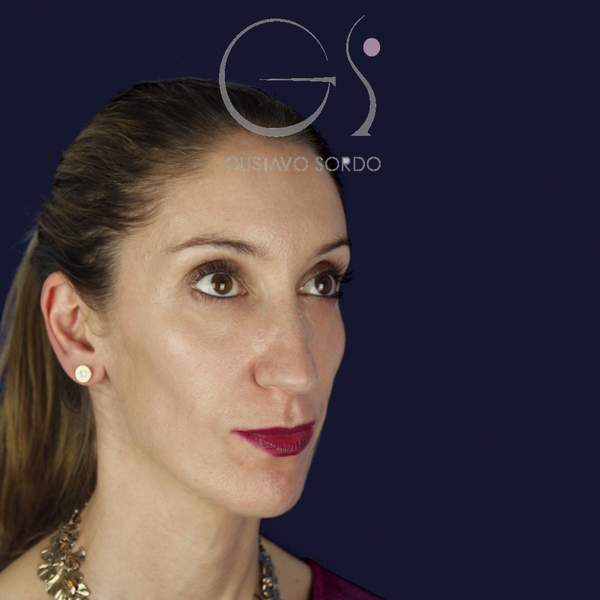 Rinoplastia en nariz larga y piel gruesa, semiperfil derecho, antes de la cirugía — caso del Dr. Gustavo Sordo en Madrid