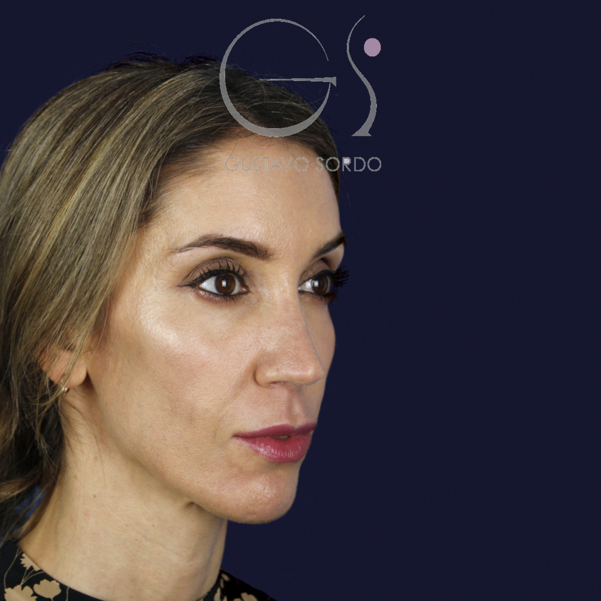 Rinoplastia en nariz larga y piel gruesa, semiperfil derecho, al año de la cirugía — caso del Dr. Gustavo Sordo en Madrid
