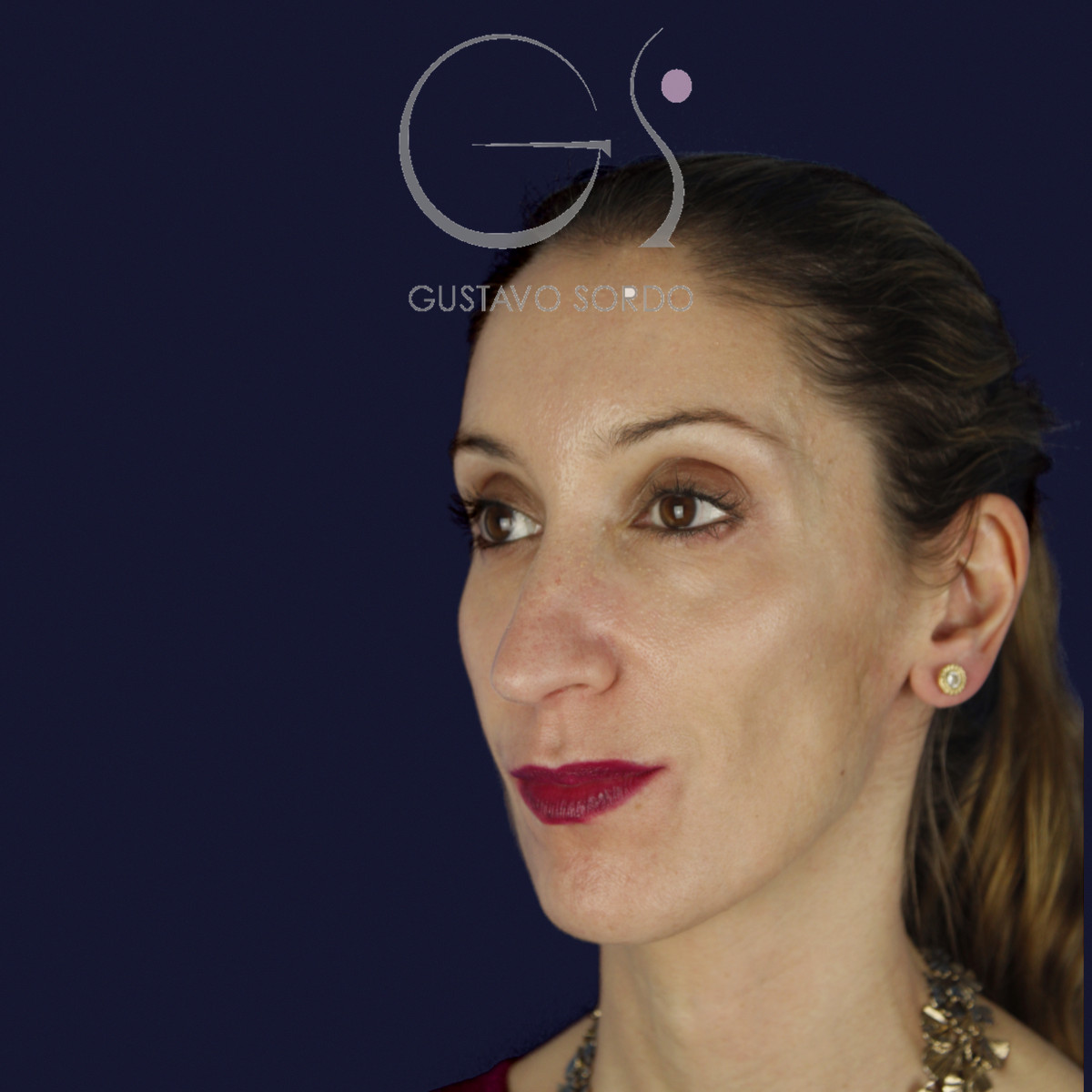 Rinoplastia en nariz larga y piel gruesa, semiperfil izquierdo, antes de la cirugía — caso del Dr. Gustavo Sordo en Madrid