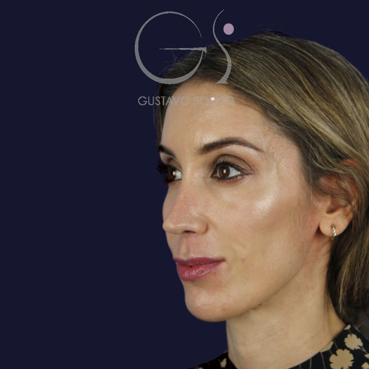 Rinoplastia en nariz larga y piel gruesa, semiperfil izquierdo, al año de la cirugía — caso del Dr. Gustavo Sordo en Madrid