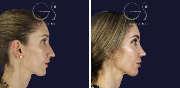 Rinoplastia en nariz larga y piel gruesa: perfil derecho antes y al año — caso del Dr. Gustavo Sordo en Madrid