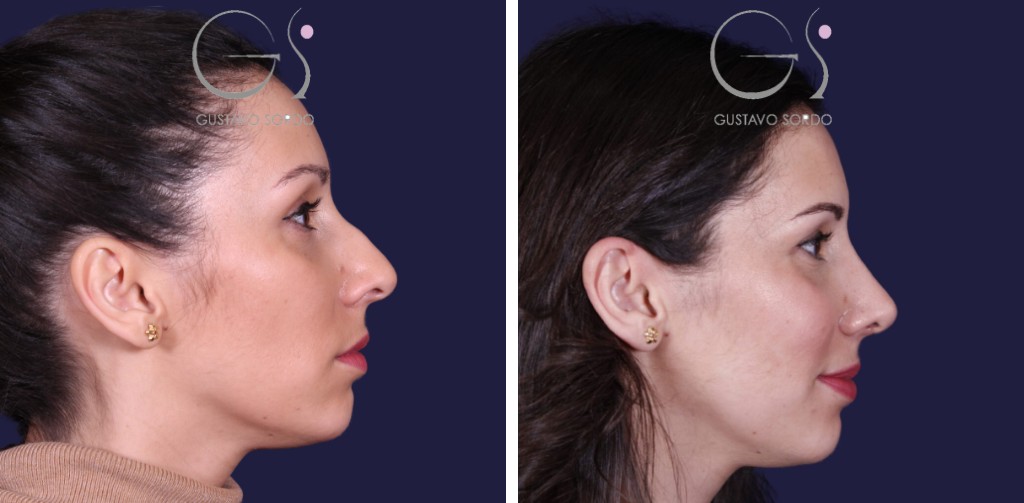 Rinoplastia: antes y después de un caso operado en Madrid