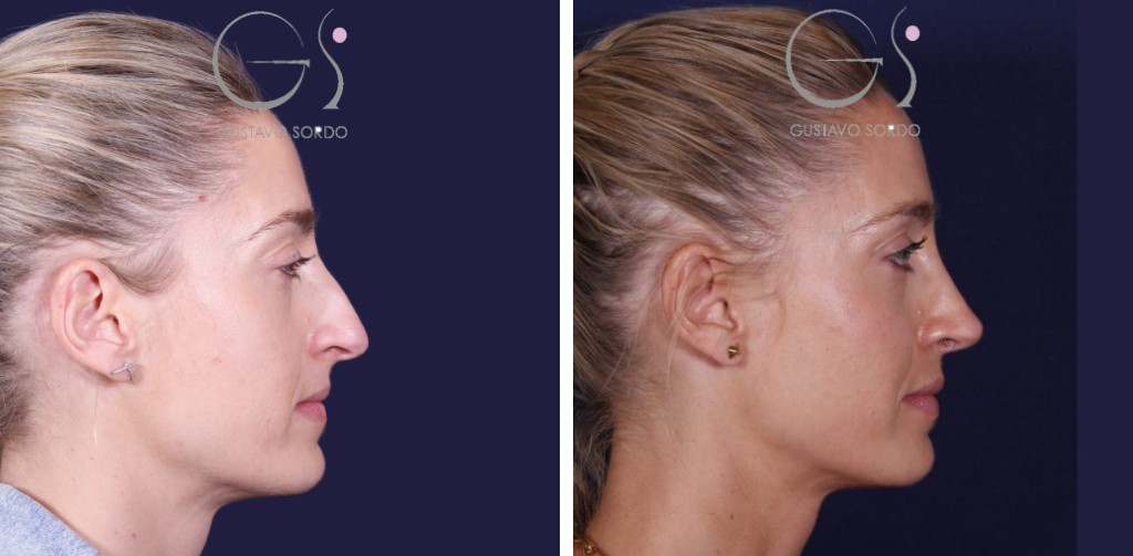 Rinoplastia: antes y después de un caso operado en Madrid