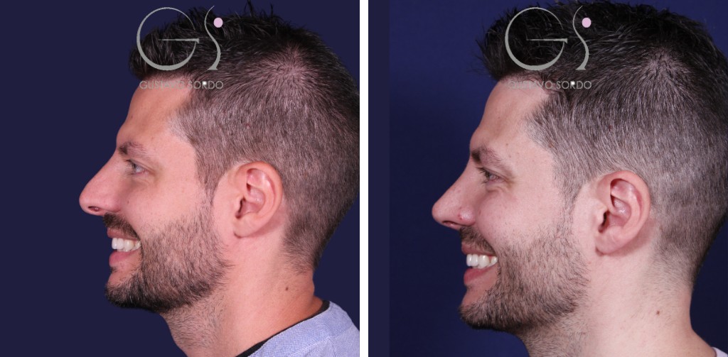 Caso de rinoplastia, antes y después (3 de 4)