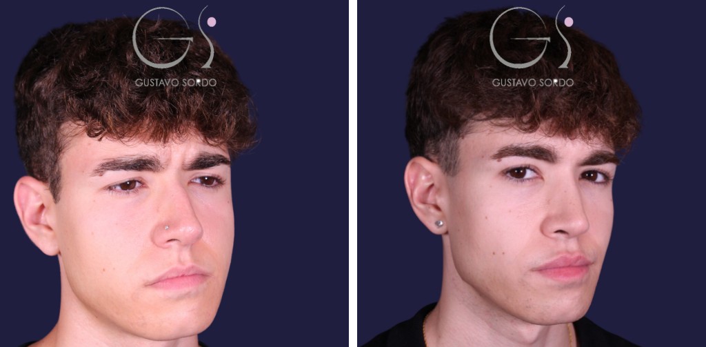 Caso de rinoplastia, antes y después (4 de 4)