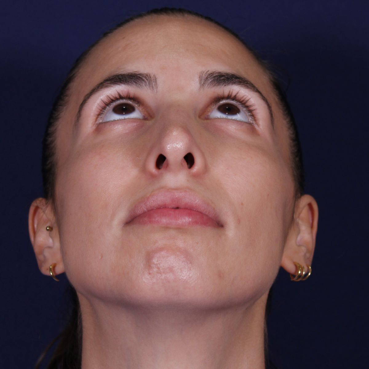 Rinoplastia estructural con injertos espaciadores y mentoplastia con implante, antes de la operación (3)