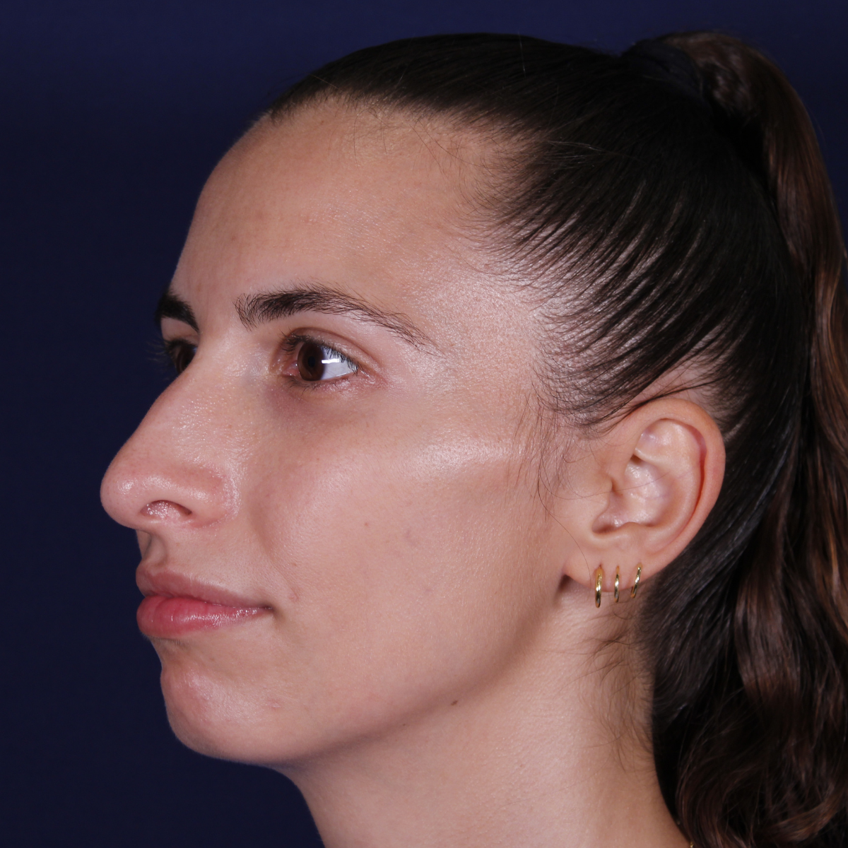 Rinoplastia estructural con injertos espaciadores y mentoplastia con implante, antes de la operación (7)