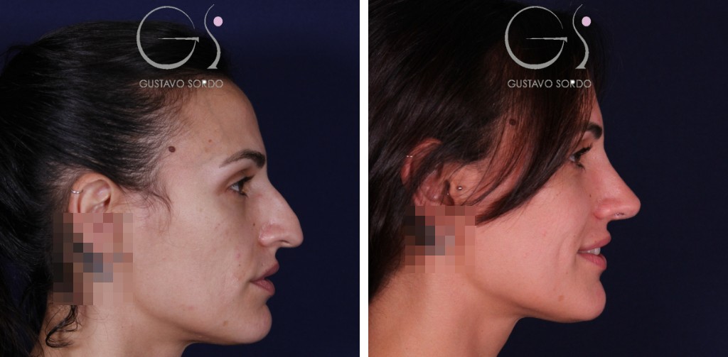 Rinoplastia: antes y después de un caso operado en Madrid