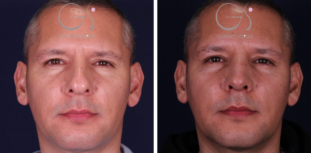 Rinoplastia — técnica de preservación: antes y después de un caso operado en Madrid