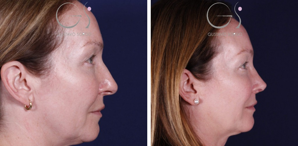 Rinoplastia secundaria: antes y después de un caso operado en Madrid