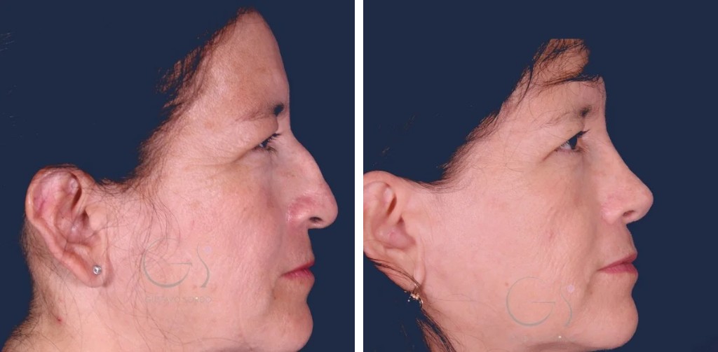 Rinoplastia étnica: antes y después de un caso operado en Madrid