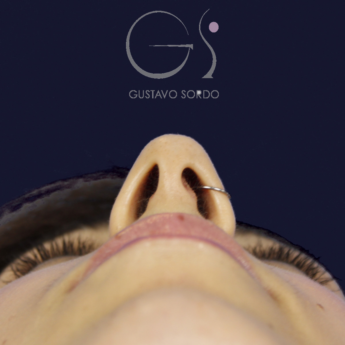 Rinoplastia estructural en piel fina con giba en S, vista basal, antes de la cirugía — caso del Dr. Gustavo Sordo en Madrid