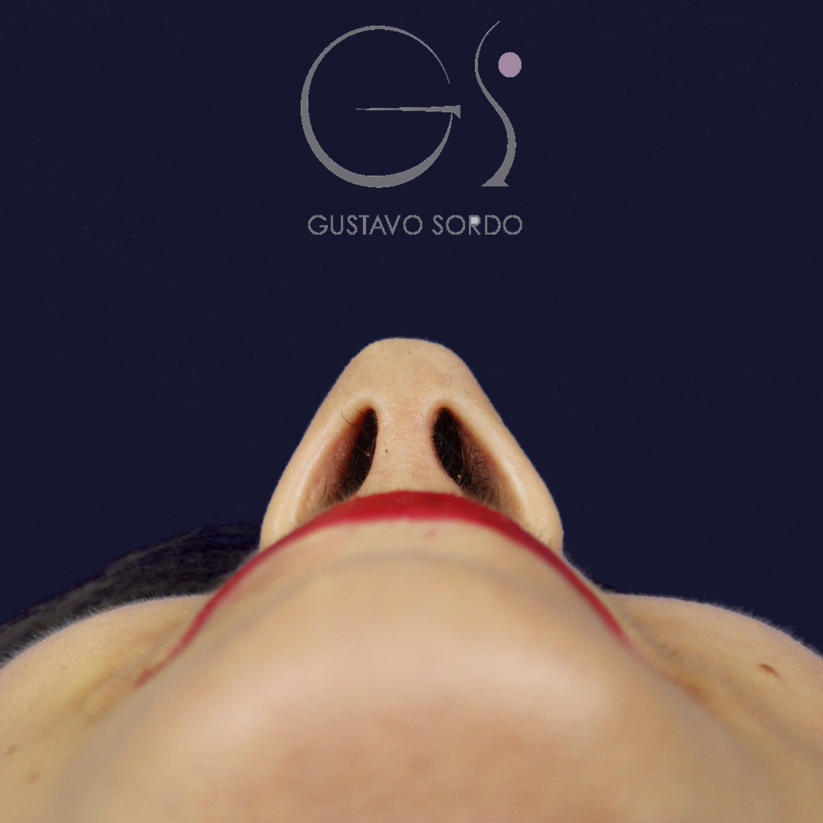 Rinoplastia estructural en piel fina con giba en S, vista basal, al año de la operación — caso del Dr. Gustavo Sordo en Madrid