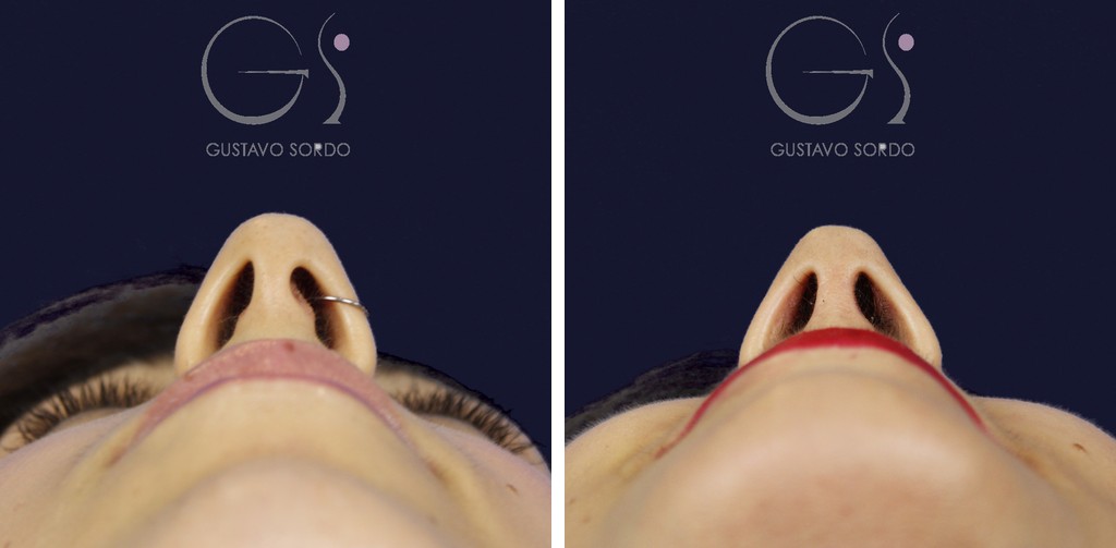 Strukturelle Rhinoplastik bei dünner Haut mit S-förmigem Nasenhöcker: Vorher- und Nachher-Bilder ein Jahr nach der Operation (Piercing entfernt). Operiert von Dr. Gustavo Sordo in Madrid.