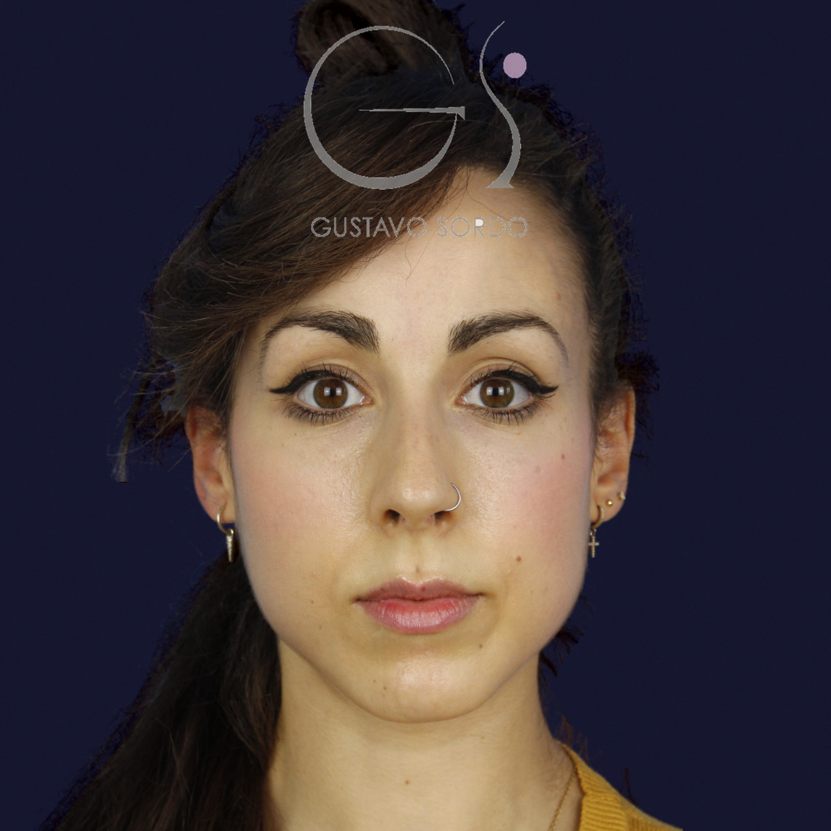 Rinoplastia estructural en piel fina con giba en S, de frente, antes de la cirugía — caso del Dr. Gustavo Sordo en Madrid