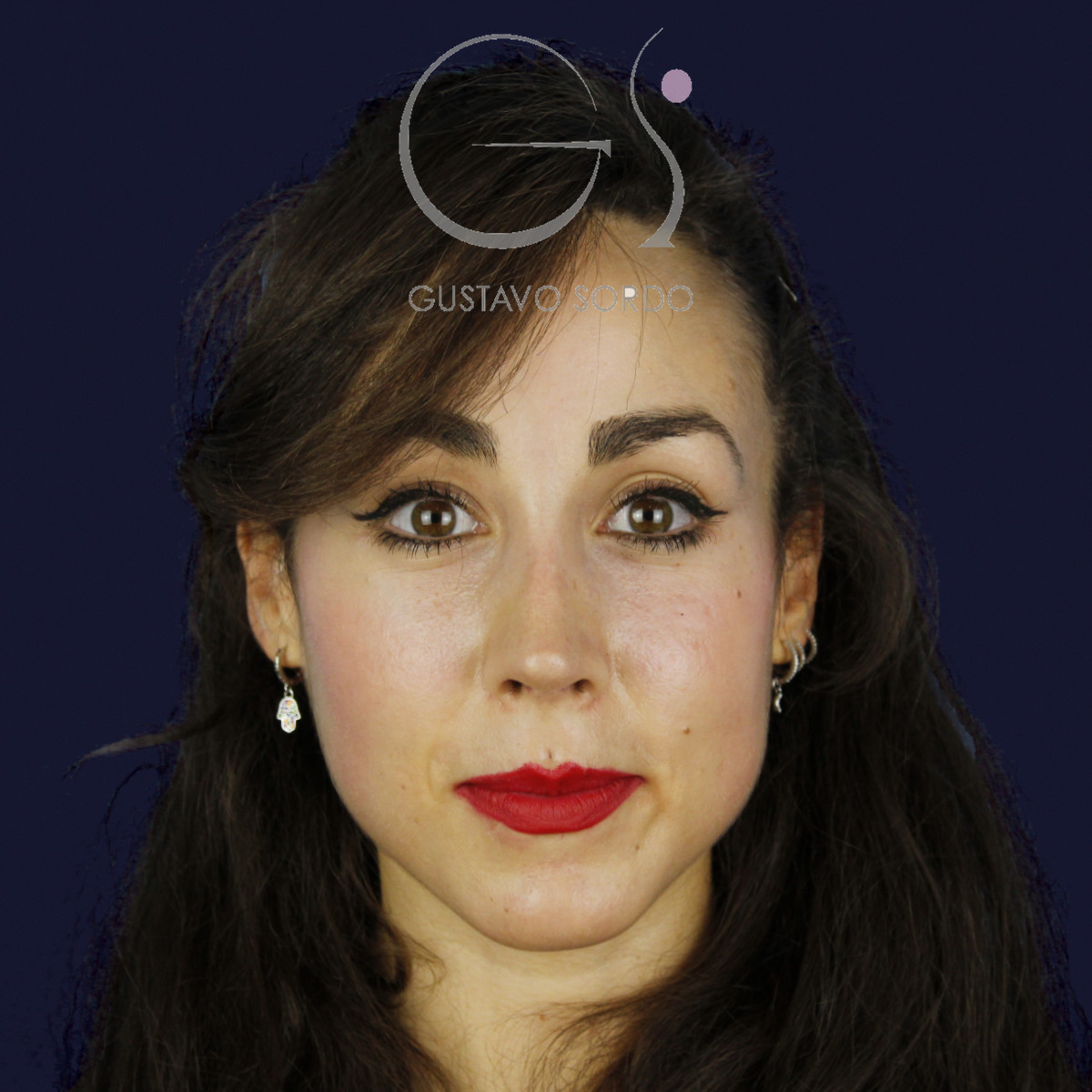 Rinoplastia estructural en piel fina con giba en S, de frente, al año de la operación — caso del Dr. Gustavo Sordo en Madrid