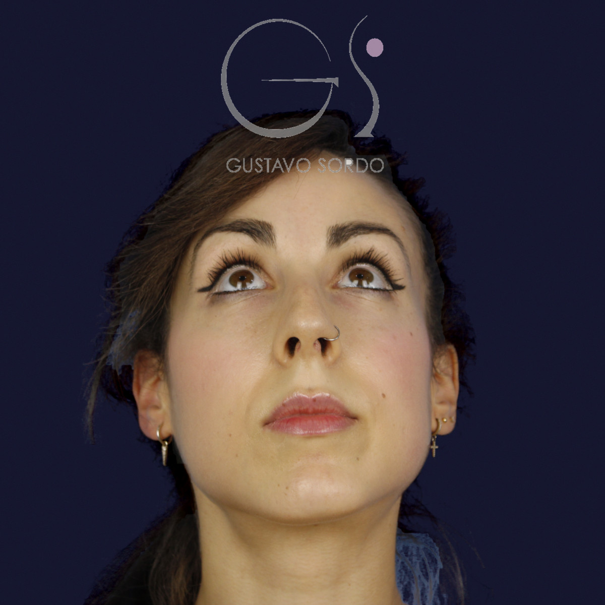 Rinoplastia estructural en piel fina con giba en S, mentón arriba, antes de la cirugía — caso del Dr. Gustavo Sordo en Madrid